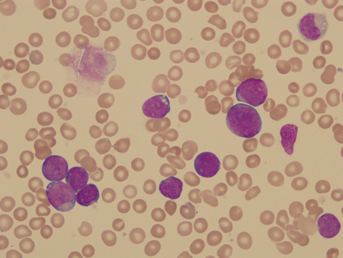 Figure 2-1. The blasts in peripheral blood smear at day 45 of patient with DS